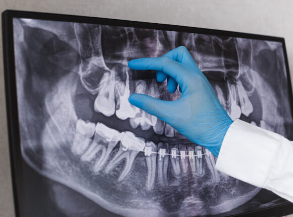 Dentist reading an xray of teeth showing how long does wisdom teeth removal take.